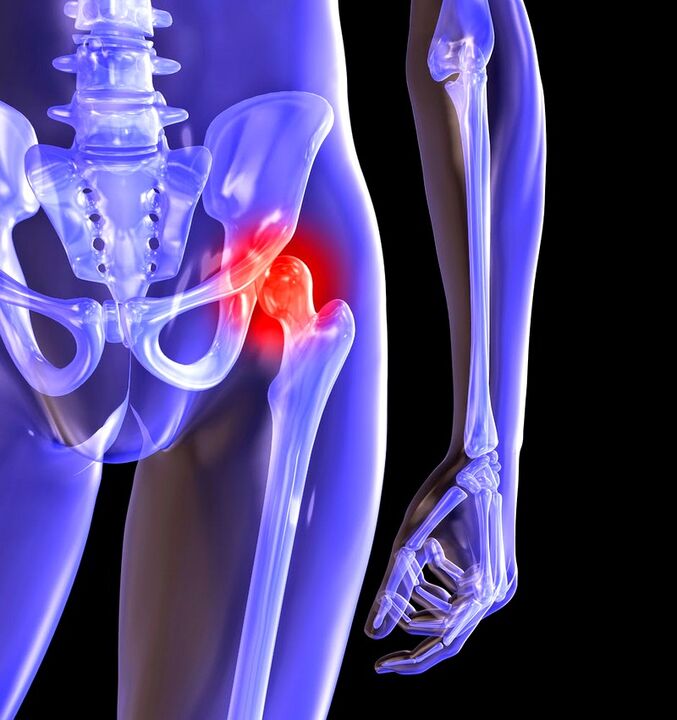 Деформатсияи артрозҳои буғуми HIP