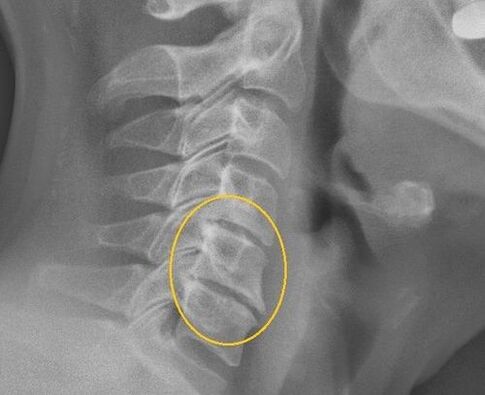 Остеохондрозии сутунмӯҳраам дар x -ray